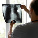 Примерно треть всех случаев рака легкого выявляют в ходе диспансеризации